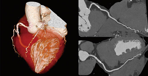 図2　Spectral Volume Scanで撮影した1volume冠動脈CT画像（画像ご提供：藤田医科大学病院様）