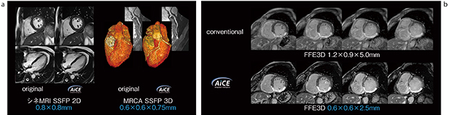 図1　心臓MRIにAiCEを適用した画像 a：シネMRI，MRCAへのAiCE適用例（ボランティア画像） b：下壁心筋梗塞症例におけるLGEのAiCE適用例（画像ご提供：杏林大学医学部付属病院様）