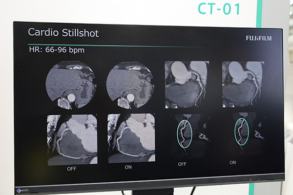 Cardio StillShotでは高心拍でもブレの少ない冠動脈画像が得られる。