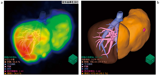 図1　非剛体位置合わせを用いた肝臓解析シミュレーション画像