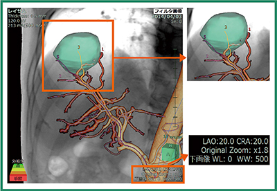 図1　IVRシミュレータで早期動脈相のCT画像から肝腫瘍に