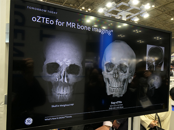 ゼロTE技術を応用し骨の描出を可能にした“oZTEo”
