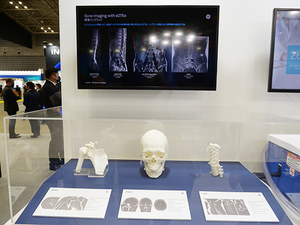 oZTEo”は独自のゼロTE技術により骨を画像化