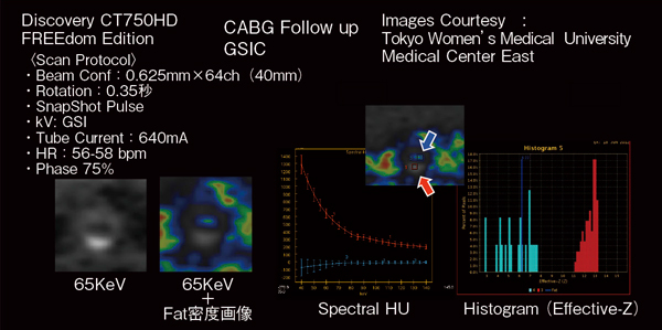 図6　従来CT表示法と脂肪密度画像＋単色X線等価画像の比較