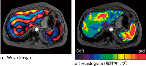 図3　線維化の進んだ肝臓におけるElastogram