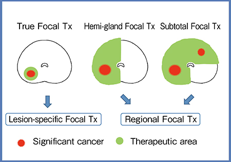 図4　Focal therapyの標的部位設定