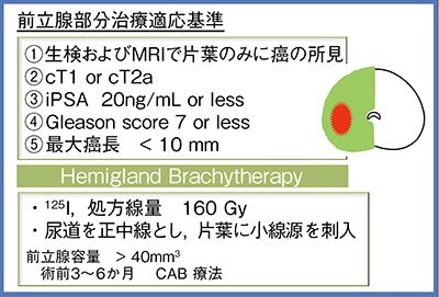 図3　前立腺片葉小線源療法の適応基準と治療法