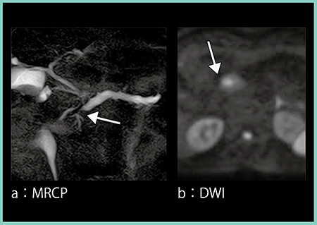図3　症例1：早期膵癌のMR画像