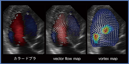 図1　VFMで観察可能なvector flow mapとvortex map