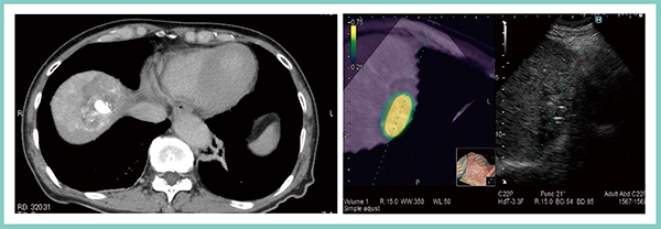 図6　症例2：心臓近傍のS8肝がんへのE-field Simulatorを用いたRFA