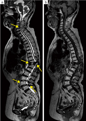 症例1：Whole spine MRI（Level1のMRI検査）
