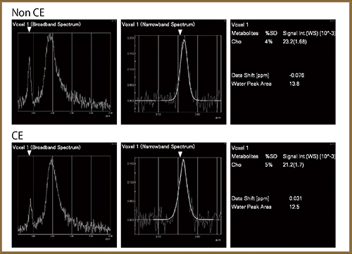 図5　Case1の初回検査における造影前（上段）と造影後（下段）のMRSの比較