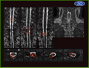 図2　多発神経鞘腫の3D撮像（PBSG）