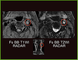 図3　頸動脈プラークイメージング（RADAR）