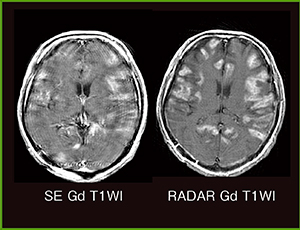 図4　急性出血性白質脳炎（RADAR）