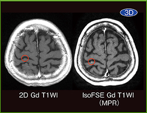 図7　多発脳転移（3D-FSE T1WI）