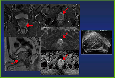 図6　生検前MRIで腫瘍の位置情報などを提供することで前立腺癌の検出率が向上