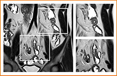図3　MRIで空腸，近位回腸に病変を指摘できた例