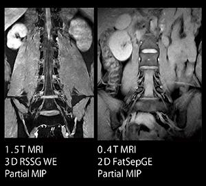 図1　MR Myelography：神経根の描出