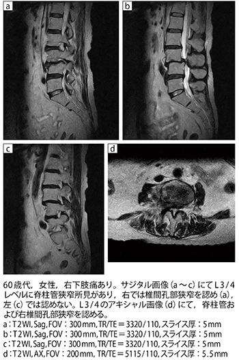 症例2：腰部脊柱管狭窄症（L3変性すべり）