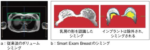 図2　Smart Exam Breastの静磁場シミング