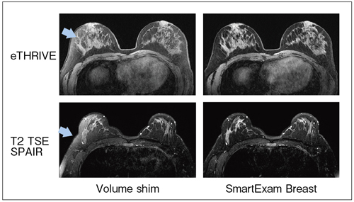 図3　Smart Exam Breastの画像比較（3.0T）