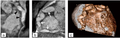 図2　MRI冠動脈三次元再構成画像