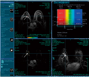図2　乳房専用の3D解析ソフト