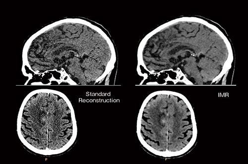 図2　IMR臨床画像（頭部単純CT）