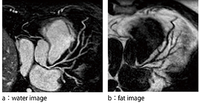 図2　mDIXON XDによる冠動脈内腔と外観の評価