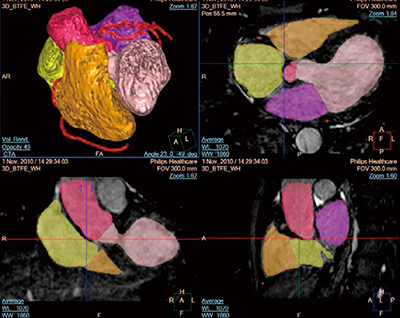 図5　MR cardiac Whole Heartによる心臓解剖学的構造の分割
