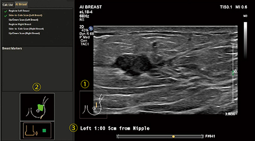 図4　AI Breast使用中の画面 (1) 自動で追従するプローブマーク，(2) 走査軌跡のペイント，(3) 乳頭腫瘤間距離の表示