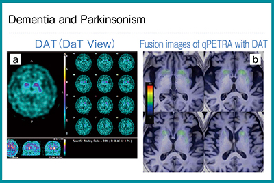 図6　症例6：70歳代，女性，痴呆・パーキンソン病 a：DATスキャン b：DATスキャンとqPETRAのフュージョン画像