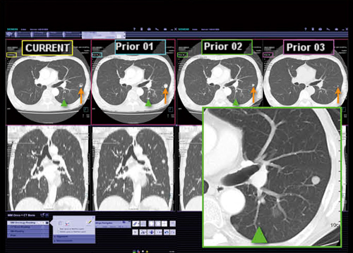 図4　MM Oncology 肺野5mm厚画像での4回分の検査の比較