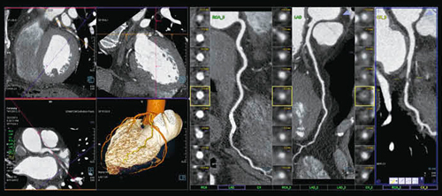 図2　syngo CT Coronary Analysis（冠動脈）