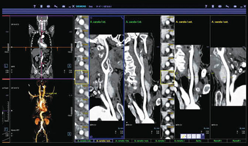 図3　syngo CT Vascular Analysisによる血管解析とsyngo CT Lung CARE 主要血管の状態を直ちに確認することができる。