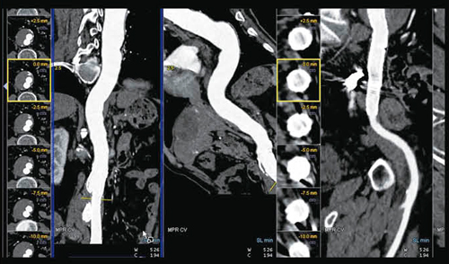 図4　‌syngo CT Vascular Analysisによる血管解析とsyngo CT Lung CARE typeⅡのエンドリークが認められる。
