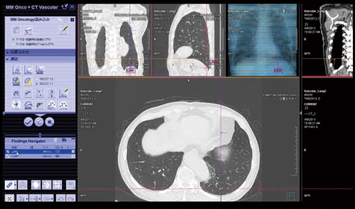 図5　‌syngo CT Vascular Analysisとsyngo CT Lung CAREによる肺結節の検出