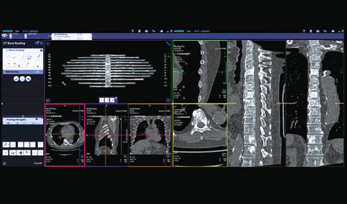 図6　syngo CT Bone Reading（骨転移の検索） 脊椎，肋骨を一括表示し，自動ラベリング