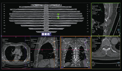 図7　syngo CT Bone Reading（骨転移の検索） 再構成画像では左第6肋骨の転移巣（▲）が明瞭である。