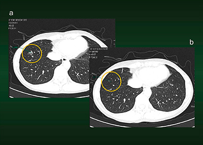 図2　症例1：Lung CAREによる経時的画像比較