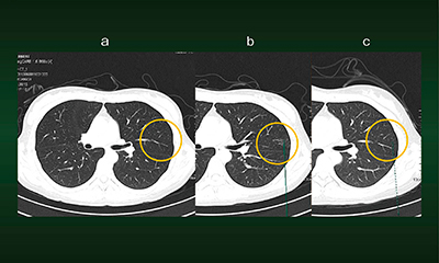 図3　症例2：Lung CAREによる経時的画像比較