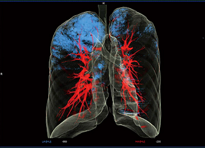 図6　症例4：Pulmo 3Dによる肺の3D画像作成