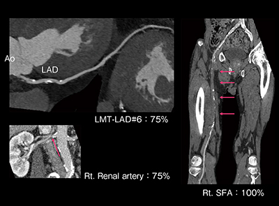 図5　症例：冠動脈・腎動脈・下肢動脈CTA一括撮影