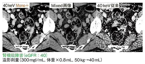 図2　症例1：直腸がん術前精査（Mono＋の40keV画像）