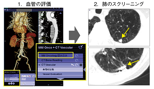 図5　症例4：大動脈瘤ステントグラフト留置後（Vascular＋Lung CARE）