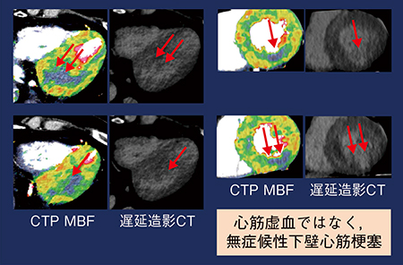 図5　症例3：MBFマップと遅延造影CT