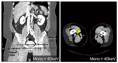 図6　症例5：深部静脈血栓症におけるMono＋の40keV画像を用いた評価