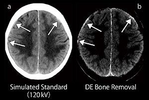 図1　硬膜下血腫の診断におけるDE Bone Removalの有用性 頭蓋骨に接した急性期の出血性病変が容易に認識できる。