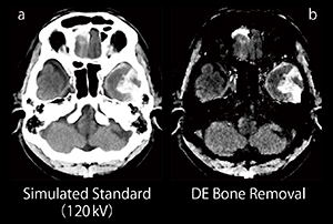 図2　頭部外傷の診断におけるDE Bone Removalの有用性